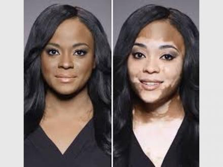 Vitiligo Solutions Clinic