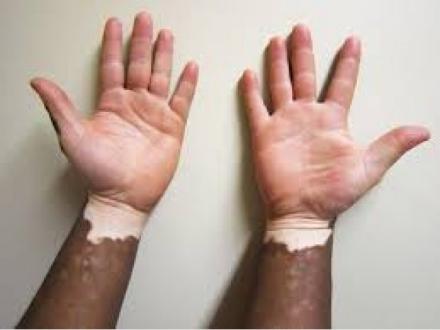 Vitiligo Solutions Clinic