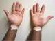 Vitiligo Solutions Clinic