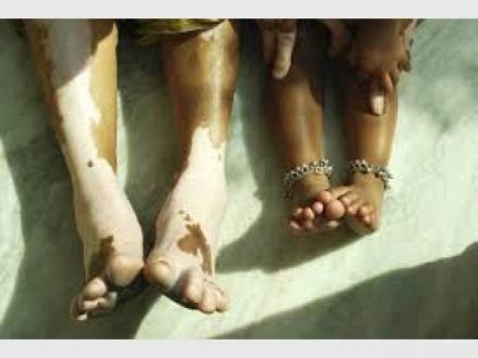 Vitiligo Solutions Clinic