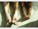 Vitiligo Solutions Clinic