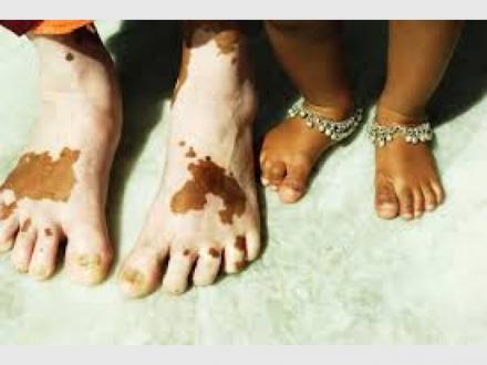 Vitiligo Solutions Clinic